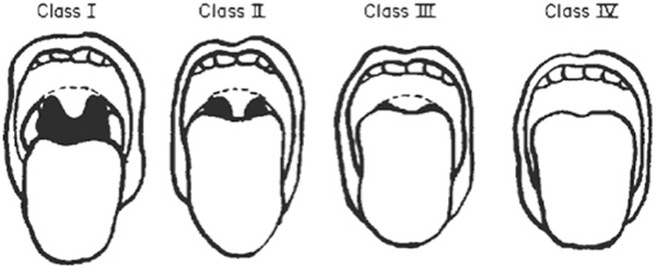 Mallampati score diagram
